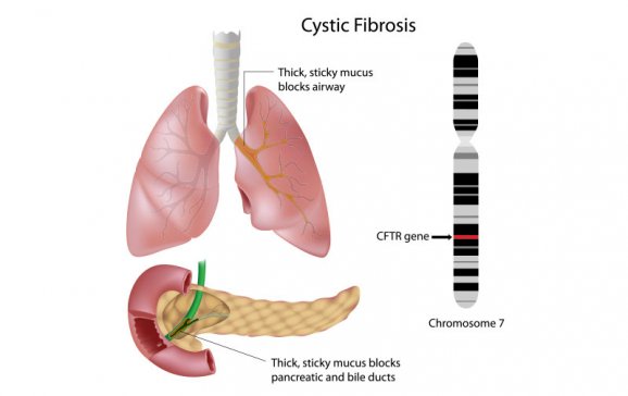 Fotogalerie Cysticka Fibroza Co Zpusobuje Toto Zavazne Dedicne Onemocneni